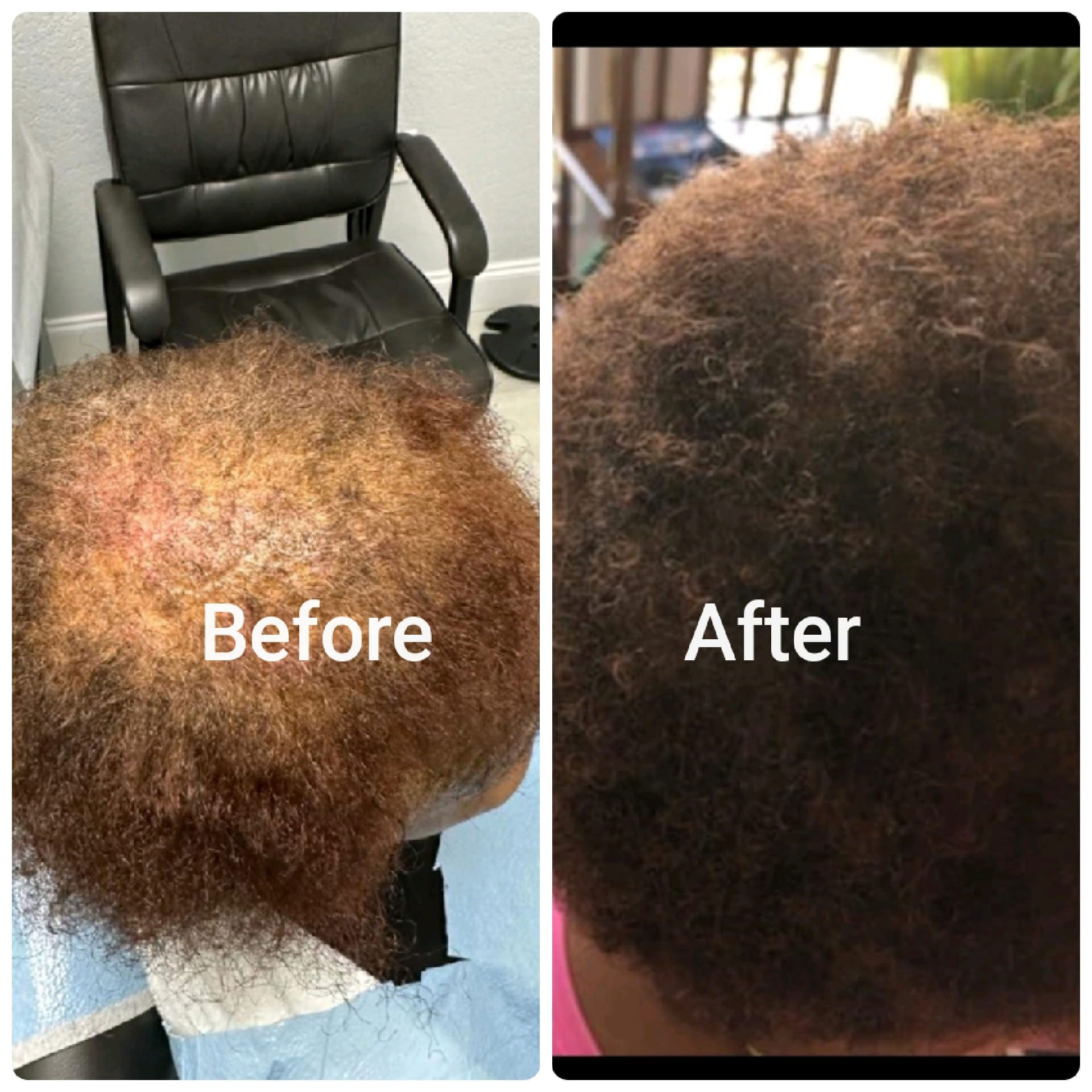 The image shows a before-and-after comparison of hair treatments, with the left side depicting a person s head with a full head of hair and the right side showing the same head after a hair treatment, with noticeable thinning.