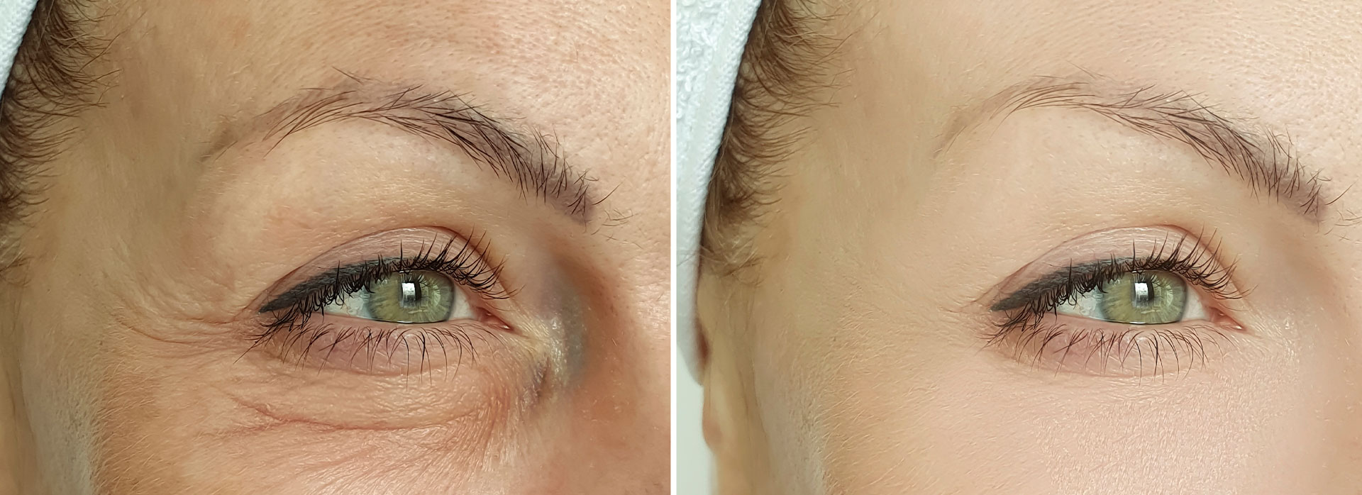 Before and after image of a person s eye area, showcasing the results of an eye treatment or cosmetic procedure.